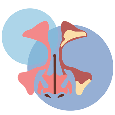 Sinusitis